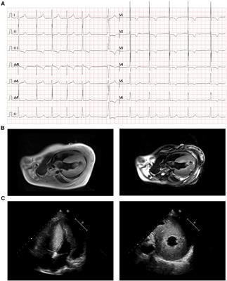 A novel compound heterozygous variant in ALPK3 induced hypertrophic cardiomyopathy: a case report